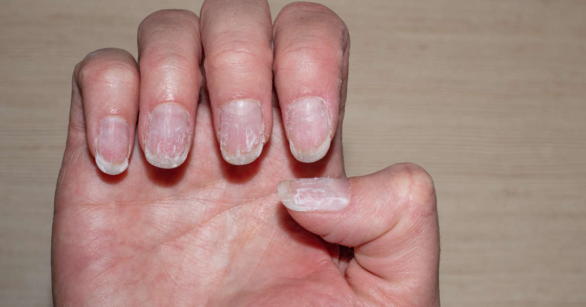 What Causes Brittle Nails and Hair Loss: Facts You Need to Know - The  Wellness Corner